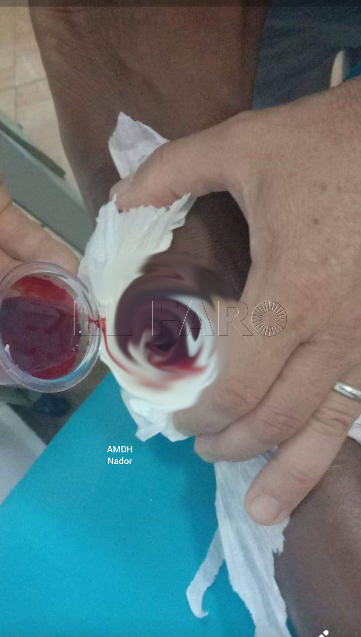 HERIDO PIXEL El subsahariano de las polémicas imágenes del salto a la valla del 3 de marzo pide ayuda