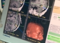 20230115 Cirugia Neuronavegacion 05 Extirpado por vez primera un tumor cerebral mediante neuronavegación en el Comarcal de Melilla