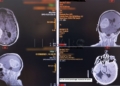 20230918 Tumor cerebral radiodiagnostico 01 Extirpado otro tumor cerebral con el sistema de Neuronavegación y el aspirador ultrasónico