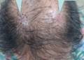 carcinoma jpg Campaña de prevención del cáncer de piel